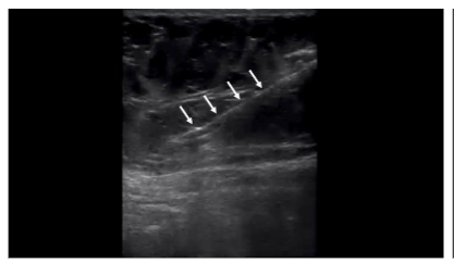 Figure 3A: Short axis to the rectus abdominis muscle, in-plane ultrasound view of the ultrasound-guided lipoaspiration. The cannula (white arrows) can be seen in the adipose layer.