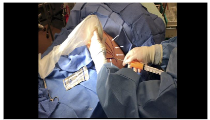Figure 3B: Corresponding external view of the ultrasound-guided lipoaspiration. The trajectory markings (white arrows), used as a guide during the aspiration, can be seen.