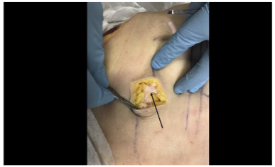 Figure 4: External view of the dissection of a cadaveric specimen following an ultrasound-guided injection of colored latex. The colored latex (black arrow) can be seen in the adipose layer.