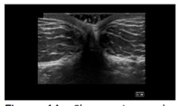 Figure 1A: Short axis to the rectus abdominis ultrasound view of the abdomen.