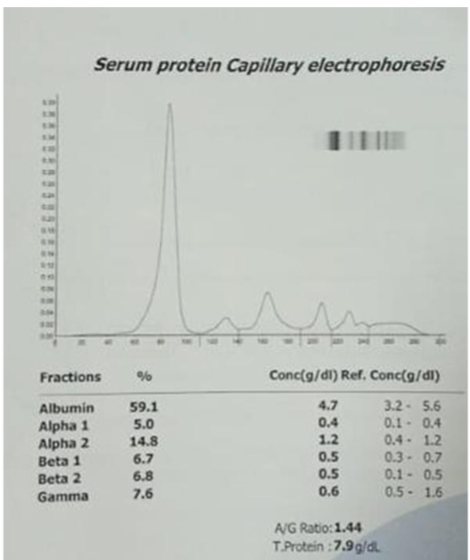 FIG 1: Serum electrophoresis appears normal.