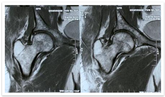 FIG 2: MRI HIP: Multiple focal altered signal intensity lesions.