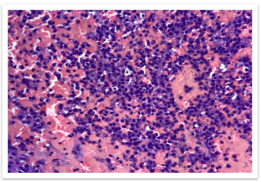 FIG 4: High power view(100x) - Clusters of plasma cells with eccentric nucleus and basophilic cytoplasm.