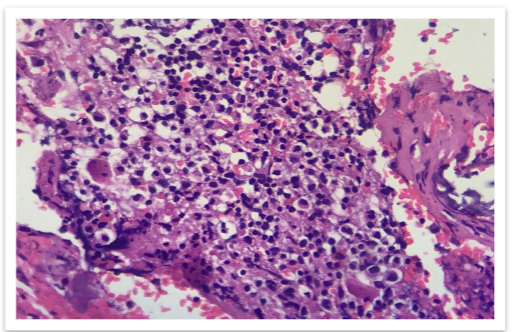 FIG 5: High power view(100x) shows clusters of plasma cells and some cells are embedded in eosinophilic osteoid stroma.
