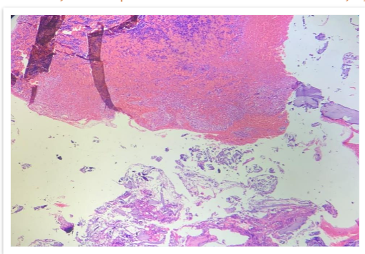 FIG 3: Scanner view shows spicules of degenerated bone and loosely arranged clusters of cells (arrow).