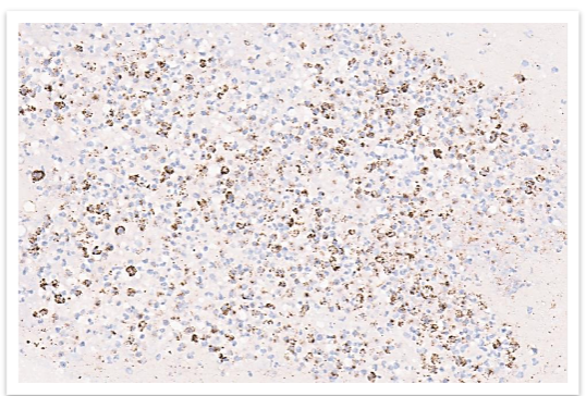 FIG 6: Immunohistochemistry shows plasmacytoid cells are positive for CD 138.