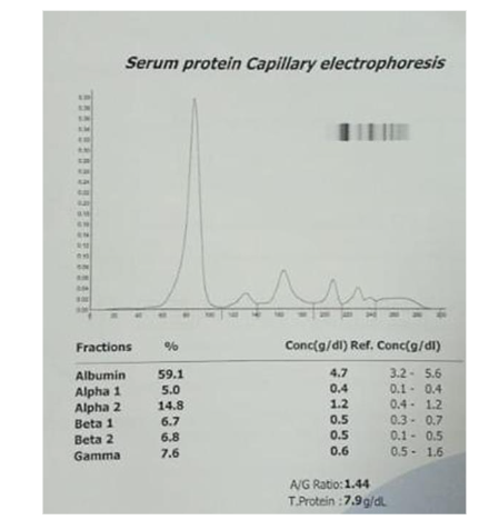 FIG 1: Serum electrophoresis appears normal.
