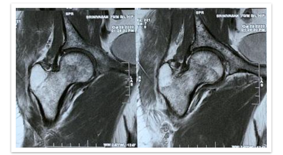 FIG 2: MRI HIP: Multiple focal altered signal intensity lesions.