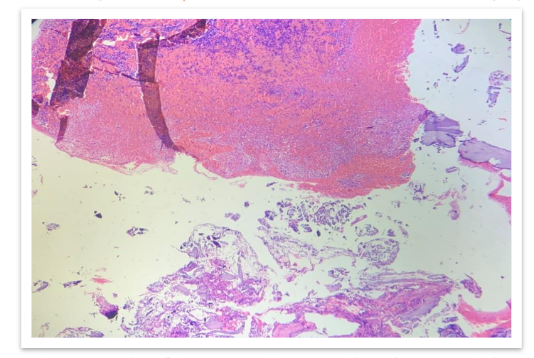 FIG 3: Scanner view shows spicules of degenerated bone and loosely arranged clusters of cells (arrow).