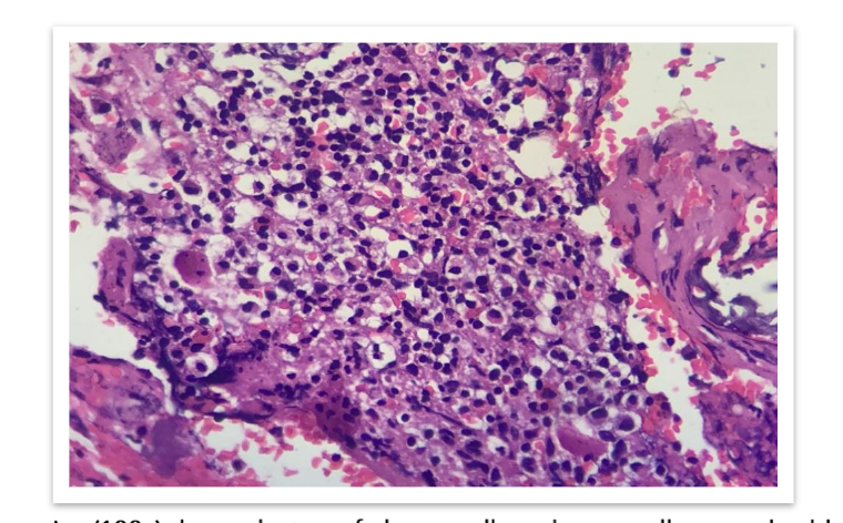 FIG 5: High power view(100x) shows clusters of plasma cells and some cells are embedded in eosinophilic osteoid stroma.