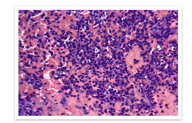 FIG 4: High power view(100x) - Clusters of plasma cells with eccentric nucleus and basophilic cytoplasm.