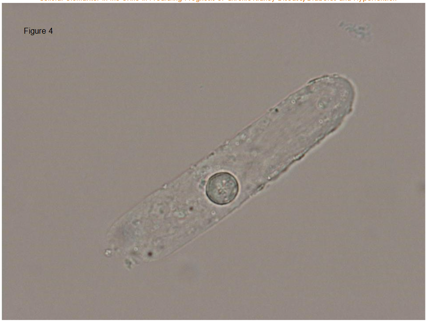 Round cell can be found in urinary cast, suggesting that the cell is derived from either glomerulus or tubules but not from ureter or lower urinary tract.