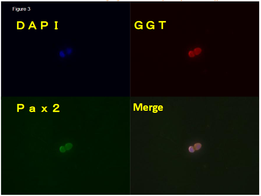 Immunostaining of round cell. Round cell is positive for GGT and Pax2 a marker of epithelial cells and undifferentiated cells respectively.