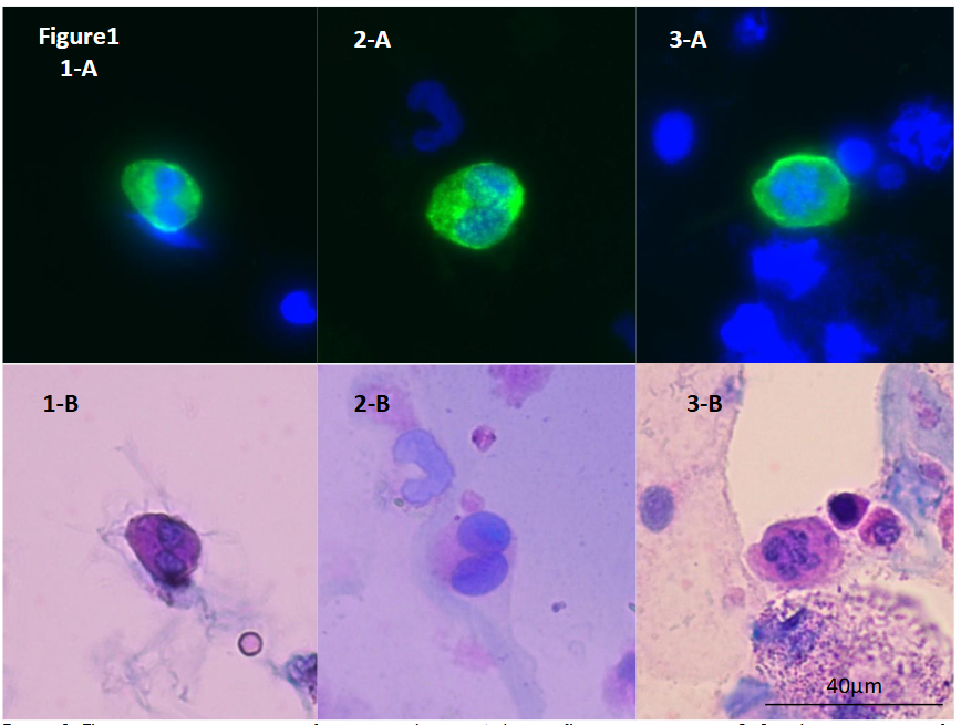 The representative images of urinary podocytes. A: Immunofluorescence staining. B: Sternheimer staining after immunofluorescence staining in the same sample.