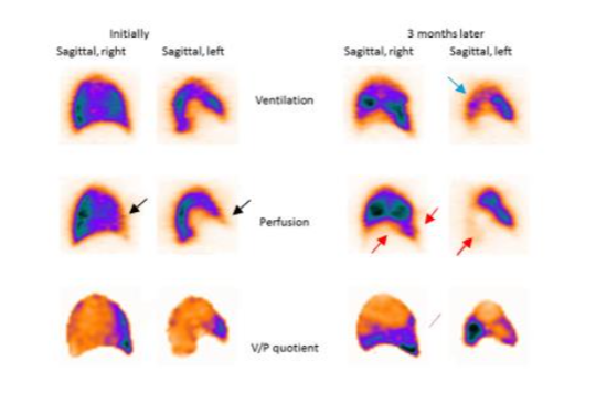 Sagittal slices of both lungs in a patient with small PE (black arrow) and pneumonia posteriorly (blue arrow). The V/P mismatch may be highlighted in V/P quotient images.