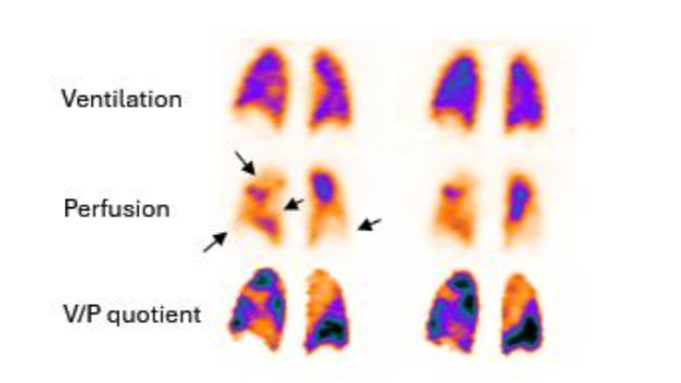 Coronal slices of both lungs in a patient with PE. Multiple bilateral segmental perfusion defects (black arrows) in areas with normal ventilation. These are delineated on V/P quotient images which facilitate interpretation.