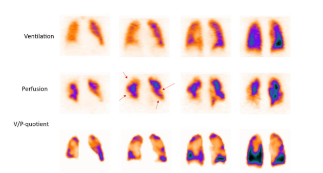 Patient with chronic PE. Coronal slices show large mainly non-segmental perfusion defects bilaterally.