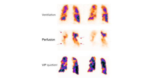 Patient with severe COPD and PE. Coronal slices: uneven distribution of ventilation with deposition of aerosols in the small airways. On perfusion images, segmental perfusion defects are observed bilaterally (red arrows), well delineated on the V/P quotient image.