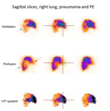 Sagittal slices of the left lung in a patient with PE in the medial lobe (red arrow) and pneumonia posteriorly (blue arrow, stripe sign). The V/P mismatch may be highlighted in V/P quotient images.