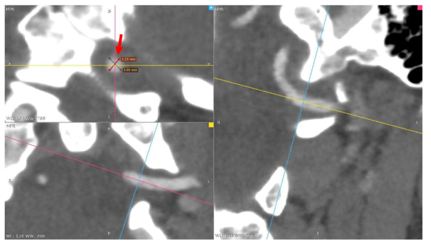 Figure 3. Head and neck are in neutral position.