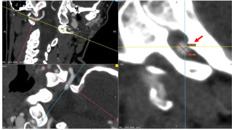 Figure 4. Head and neck are rotated to the right side.
