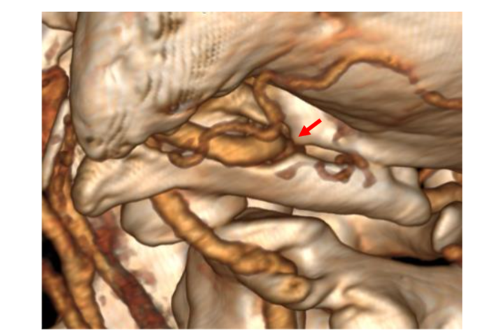 Figure 7. CTA 3D Rotation C0-1-2 to the right side.