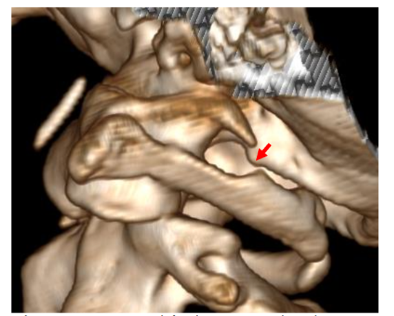 Figure 5: CT 3D C0-1-2, left side. Rotation to the right.