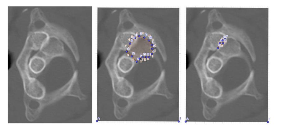 JOINT FACET REST-COVERAGE OF THE C1-2 SEGMENT DURING ROTATION RIGHT/ LEFT SIDE