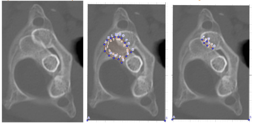 Figure 2. C1-C2 rotation left (mirrored).