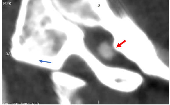 Figure 6: CT Angiography C0-1-2, left side.