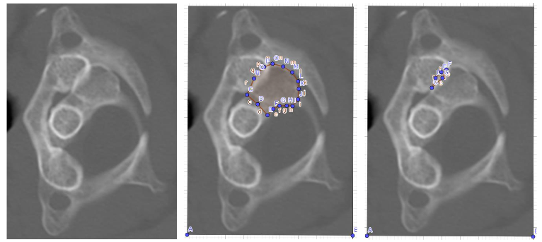 JOINT FACET REST-COVERAGE OF THE C1-2 SEGMENT DURING ROTATION RIGHT/ LEFT SIDE