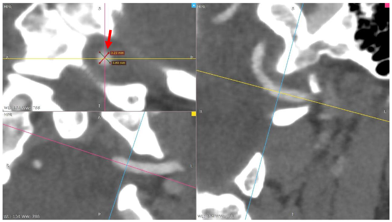 Head and neck are in neutral position.