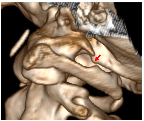 CT 3D C0-1-2, left side. Rotation to the right.