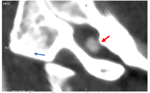 CT Angiography C0-1-2, left side.