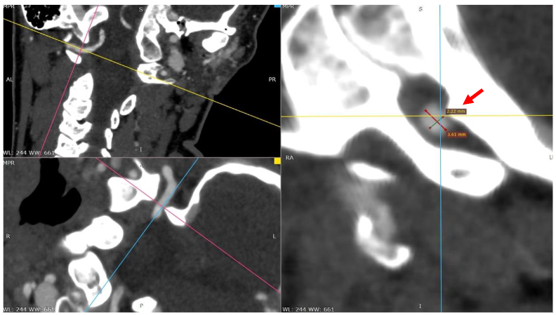 Head and neck are rotated to the right side.