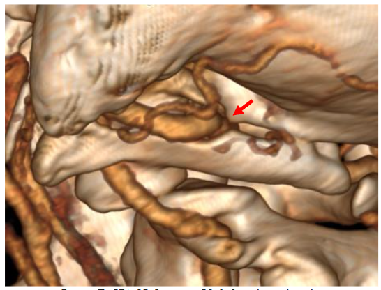 CTA 3D Rotation C0-1-2 to the right side.