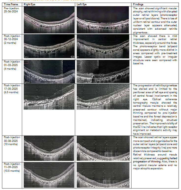 Figure 2. Serial Optical Coherence Tomography progression images following pre and post Wharton’s Jelly-Derived Mesenchymal Stem Cells injection in a patient with Retinitis Pigmentosa.
