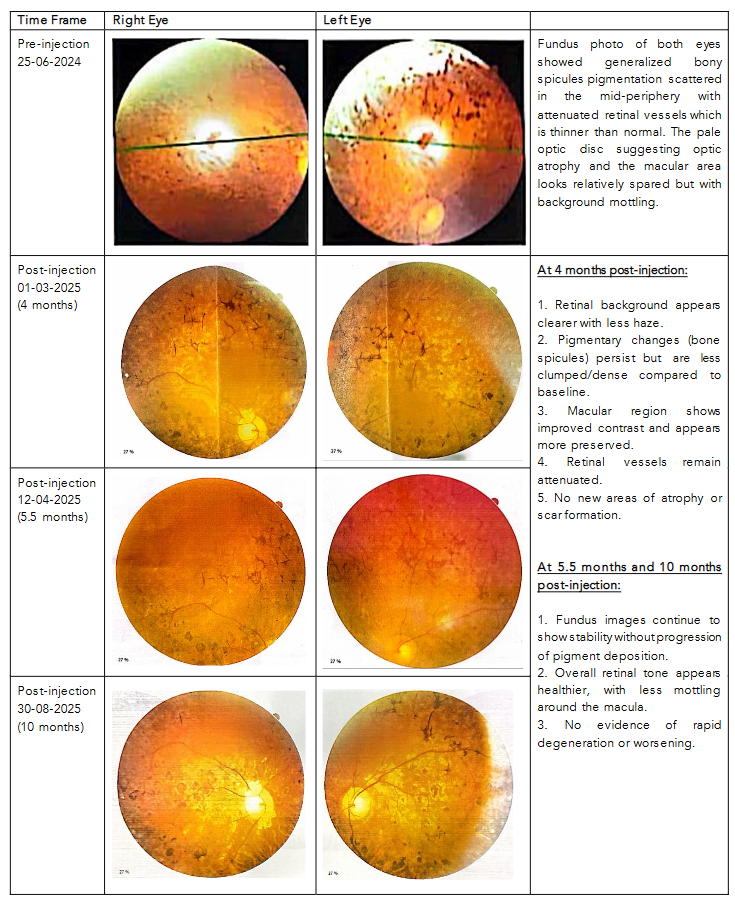 Figure 1. Serial fundus photographs pre and post Wharton’s Jelly-Derived Mesenchymal Stem Cells injection in a patient with Retinitis Pigmentosa